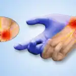 Non-surgical neuropathy treatment