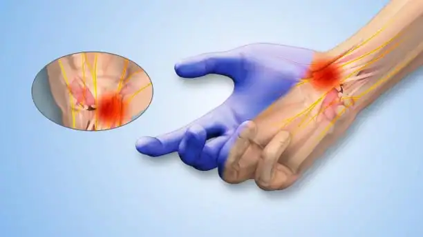 Non-surgical neuropathy treatment