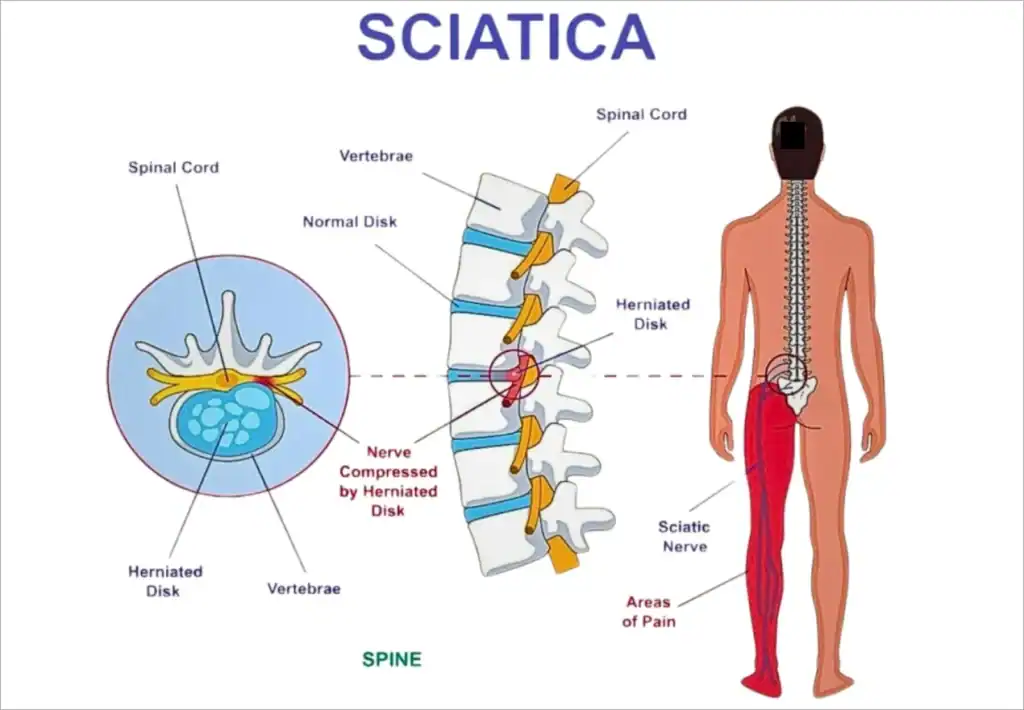 An explanatory flow diagram showing how focused chiropractic adjustments disrupt the chronic pain cycle.