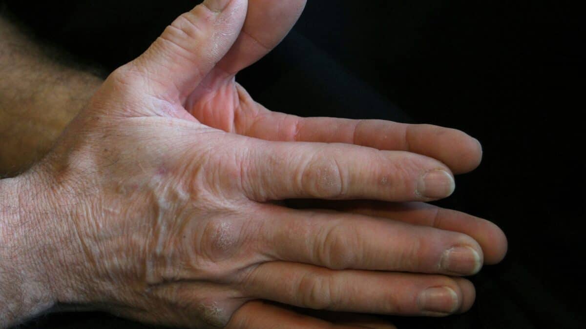 Close-up of a hand showing signs of nerve damage evaluated at a neuropathy clinic.