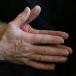 Close-up of a hand showing signs of nerve damage evaluated at a neuropathy clinic.