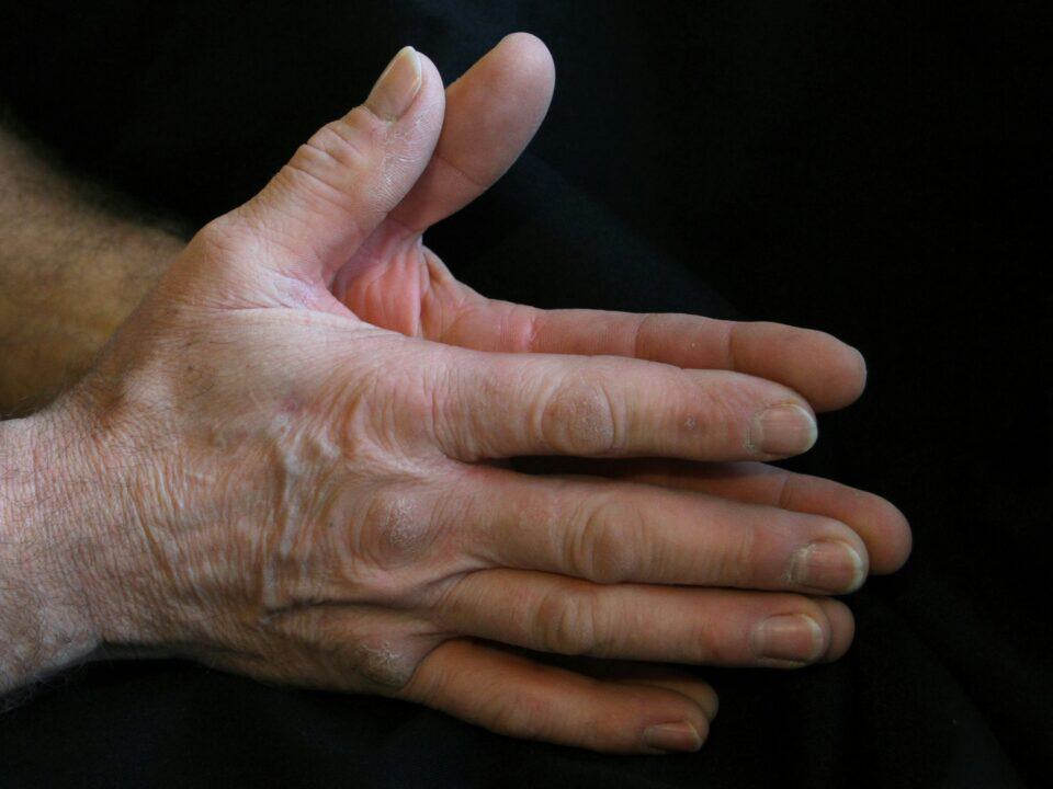 Close-up of a hand showing signs of nerve damage evaluated at a neuropathy clinic.